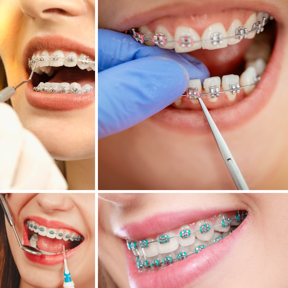 Lingual Braces & Combination - Mount Elizabeth Orthodontic Clinic