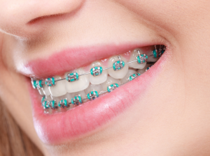 A woman with braces smiling brightly at Alfred Cheng Orthodontic Clinic, showcasing her confidence and happiness.