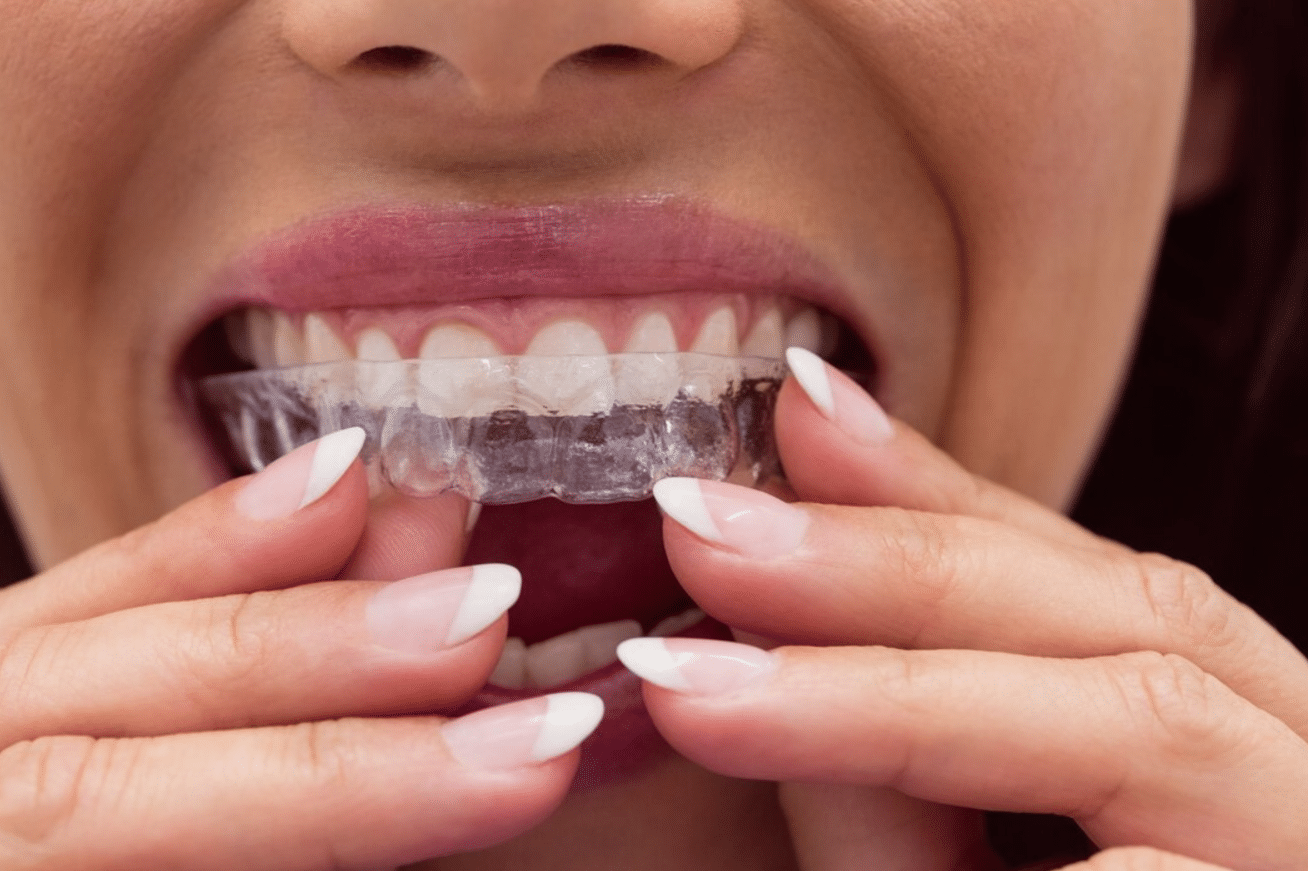 Clear aligners at Alfred Cheng Orthodontic Clinic will help straighten you smile in no time.
