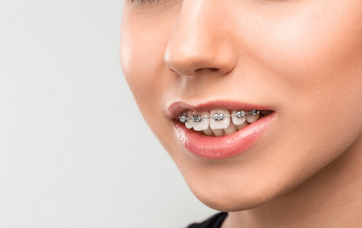 A woman with braces smiles confidently at the Alfred Cheng Orthodontic Clinic.