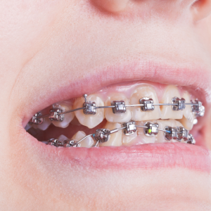A woman with braces smiles confidently at the Alfred Cheng Orthodontic Clinic.